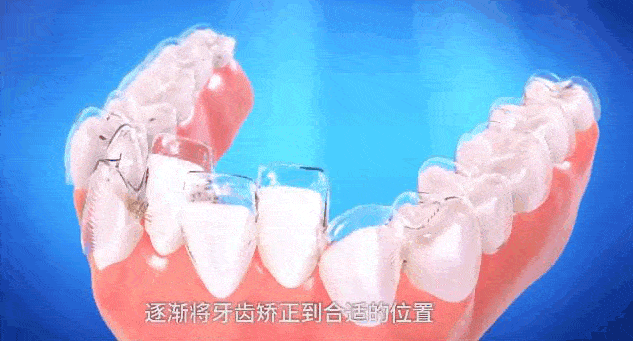 价格三千与价格一万的牙齿矫正，差别在哪里? 图片-8
