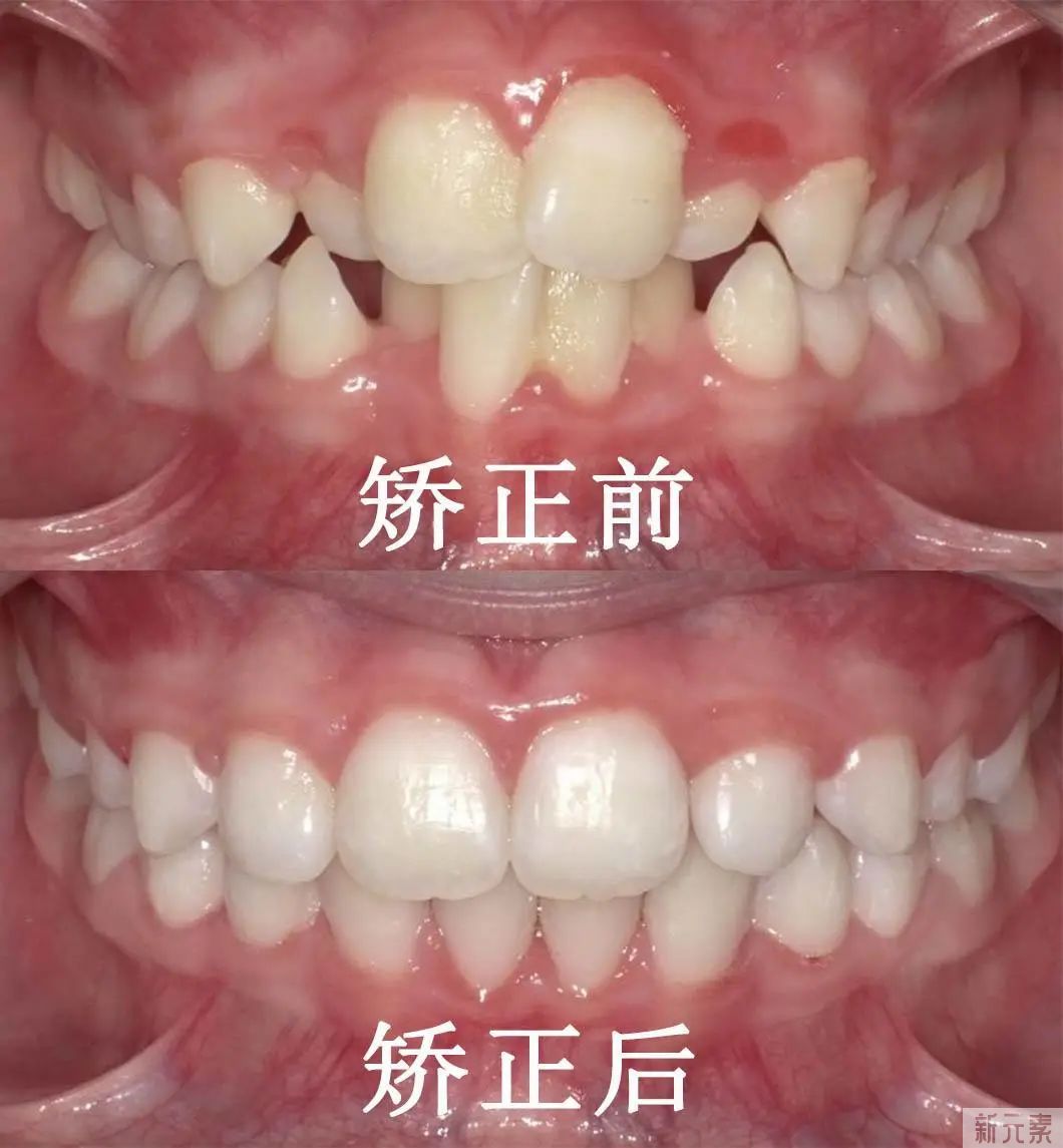 价格三千与价格一万的牙齿矫正，差别在哪里? 图片-11