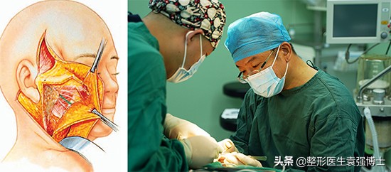 50、60岁打算做拉皮的人，先听医生说完这些事，不吃亏 图片-2