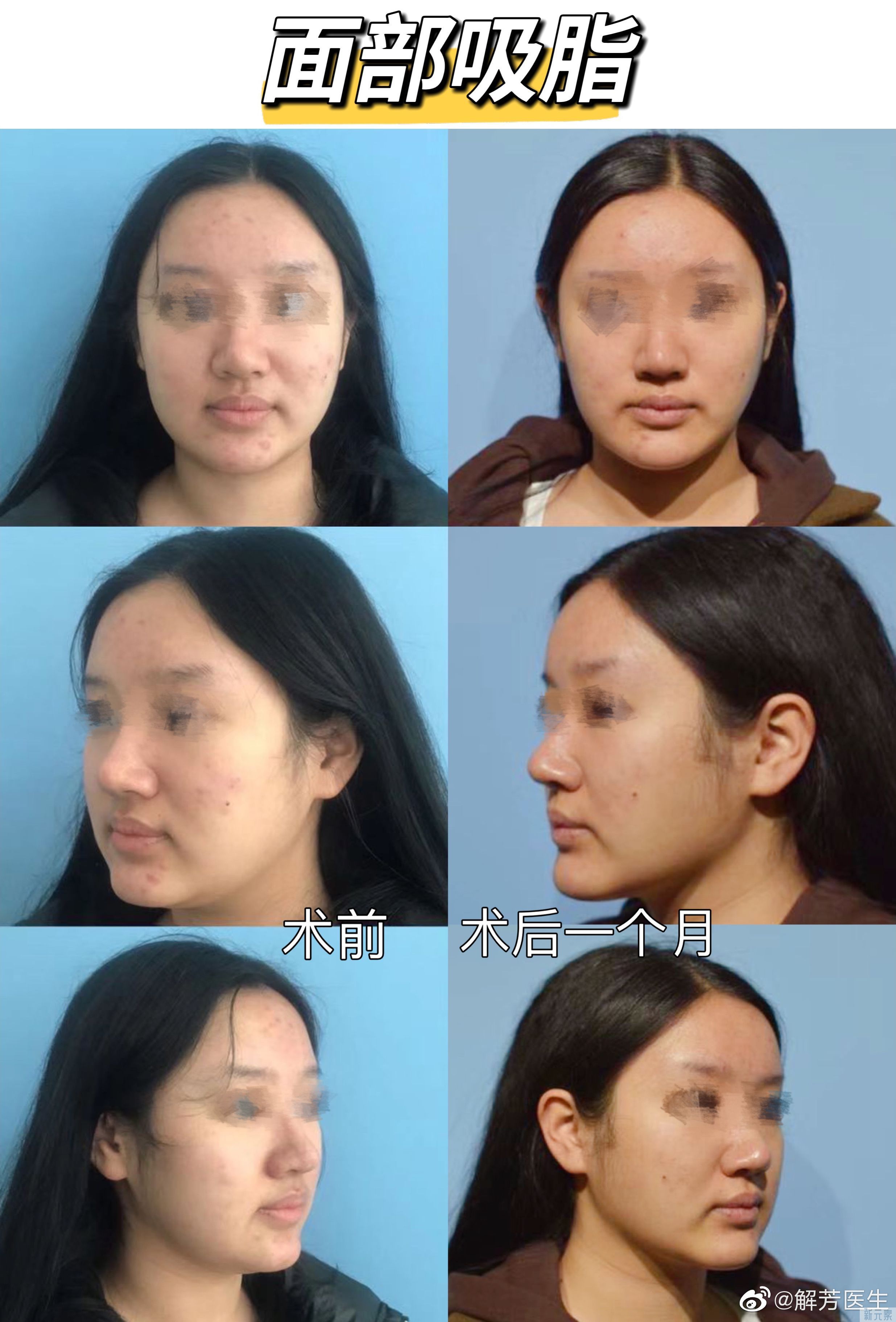 #面部轮廓整形# 面部吸脂:消灭双下巴! 图片-1