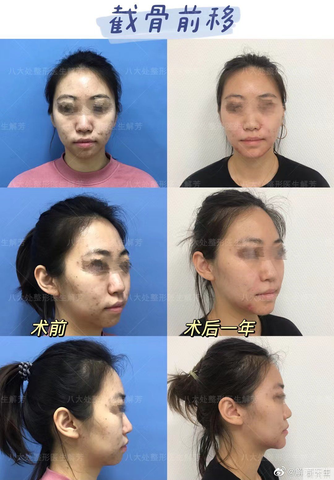 #面部轮廓整形# 截骨前移术后1年分享 图片-1