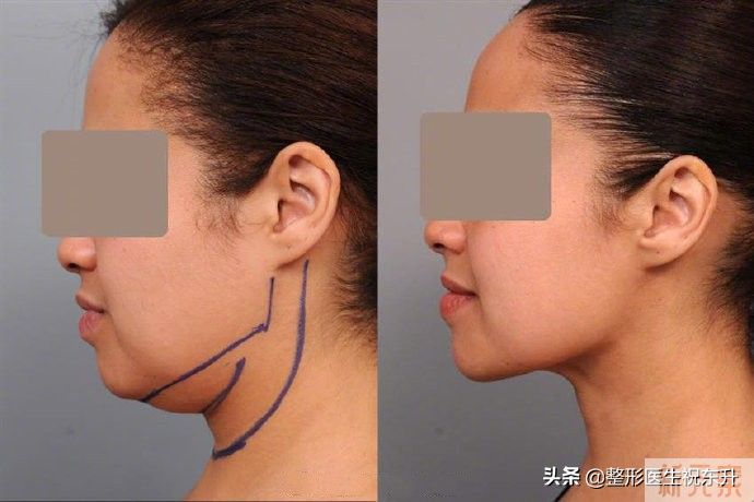 关于面部吸脂，我有几点想说的: 图片-1
