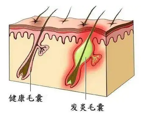 花数千元的“头皮深层清洁”是智商税?春季养发要牢记! 图片-8