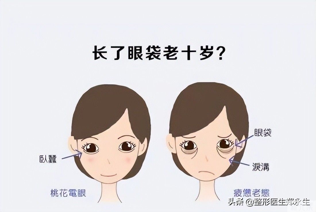 妈妈的眼袋和你的眼袋有什么不同，去眼袋方法能选择一样的吗? 图片-3