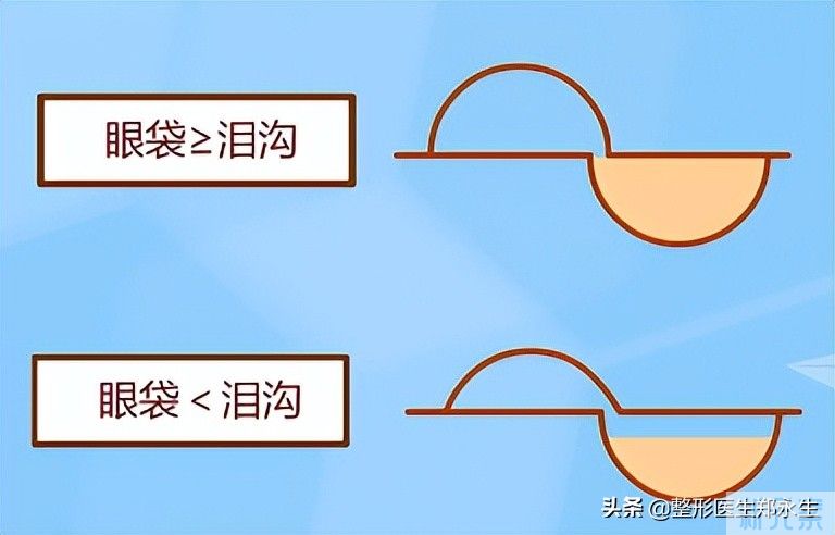 妈妈的眼袋和你的眼袋有什么不同，去眼袋方法能选择一样的吗? 图片-8