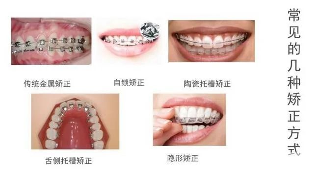 矫正拔牙后的缝隙可以恢复吗?需要多久? 图片-2