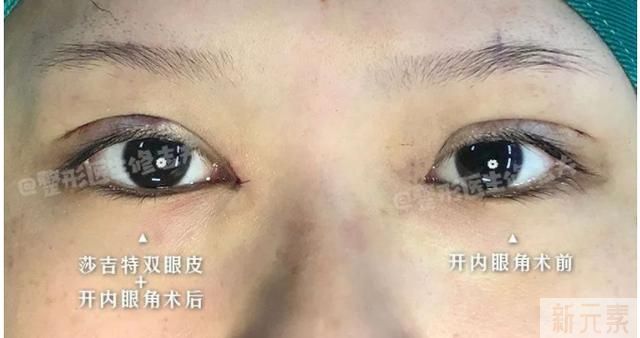 眼距宽是种什么体验? 图片-4