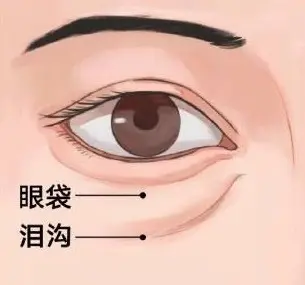 手术去眼袋会复发吗?搞清这一点，别花冤枉钱 图片-5