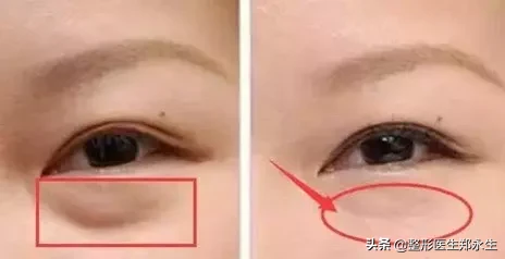 为什么做完眼袋反而凹陷了? 图片-1
