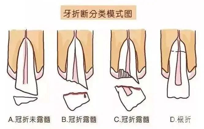 学会牙外伤急救，磕断的牙齿还能活! 图片-8