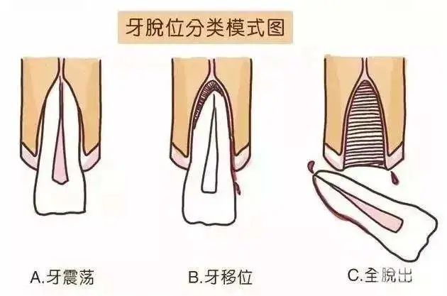学会牙外伤急救，磕断的牙齿还能活! 图片-11