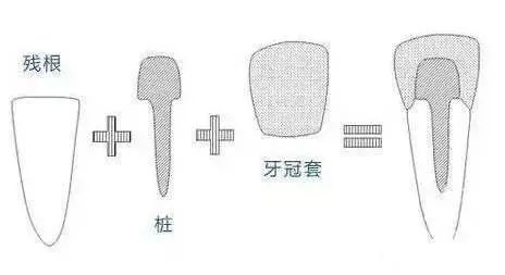 学会牙外伤急救，磕断的牙齿还能活! 图片-10