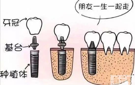 拔牙一年后再做种植牙，会影响效果吗? 图片-6