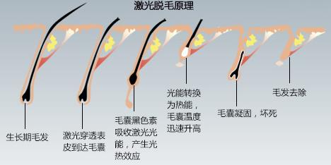 冰点脱毛是什么体验? 图片-2