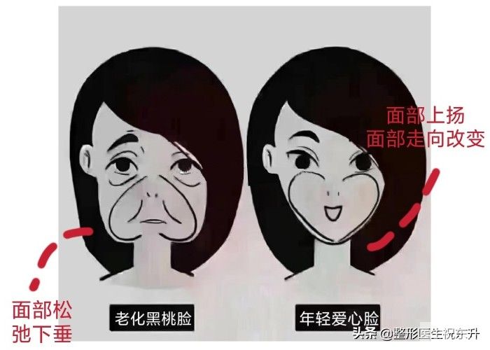做不做面部提升手术变化大吗? 图片-1