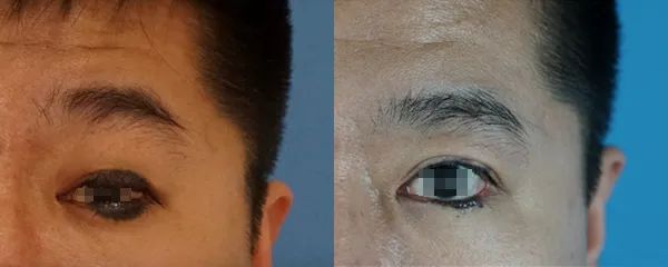 治疗眼睑黑痣的微创整形手术方案 图片-2
