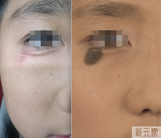 治疗眼睑黑痣的微创整形手术方案 图片-7