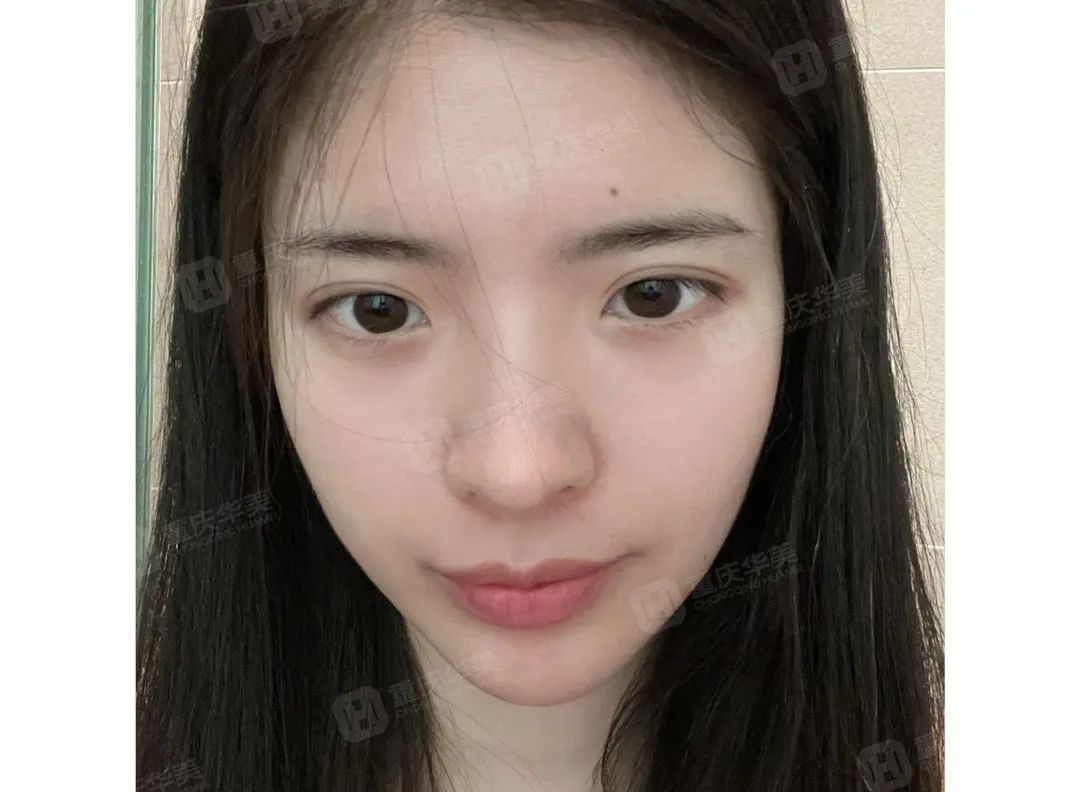 100元和1000元的光子嫩肤，到底有什么区别? 图片-7