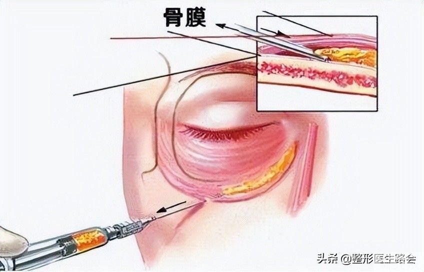 泪沟填充有6大常见方法(2)想知道哪种更适合你吗? 图片-3