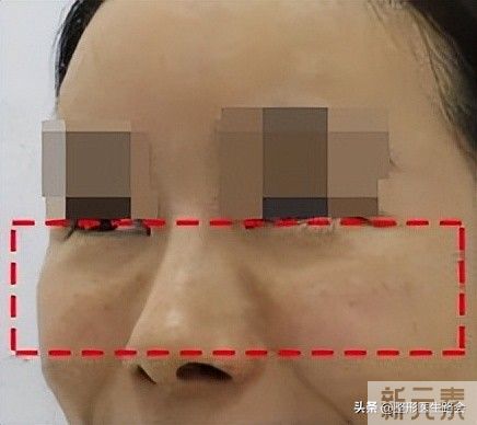 泪沟填充有6大常见方法(2)想知道哪种更适合你吗? 图片-4