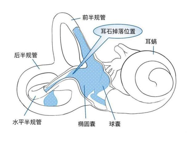 翻身眩晕、天旋地转——耳石症盯上了年轻人 图片-6