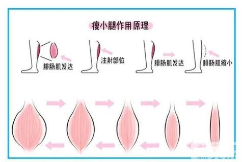 关于瘦腿，注射瘦腿vs吸脂，哪个效果更好? 图片-6