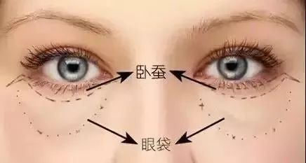 博仕女神季·如何判断自己是否要祛眼袋? 图片-2