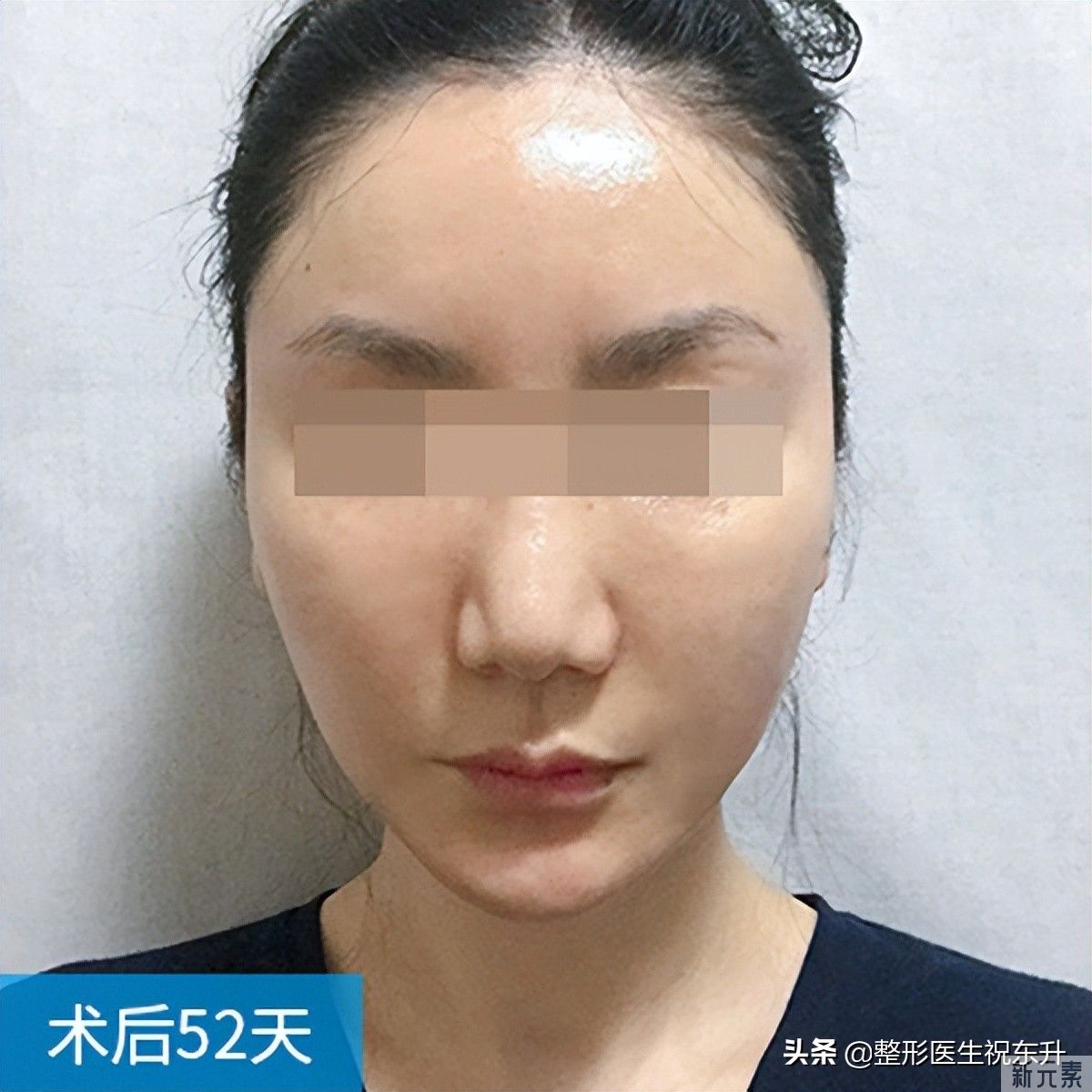 42岁大姐做了拉皮，终于摆脱自卑，变身漂亮“小姐姐” 图片-3