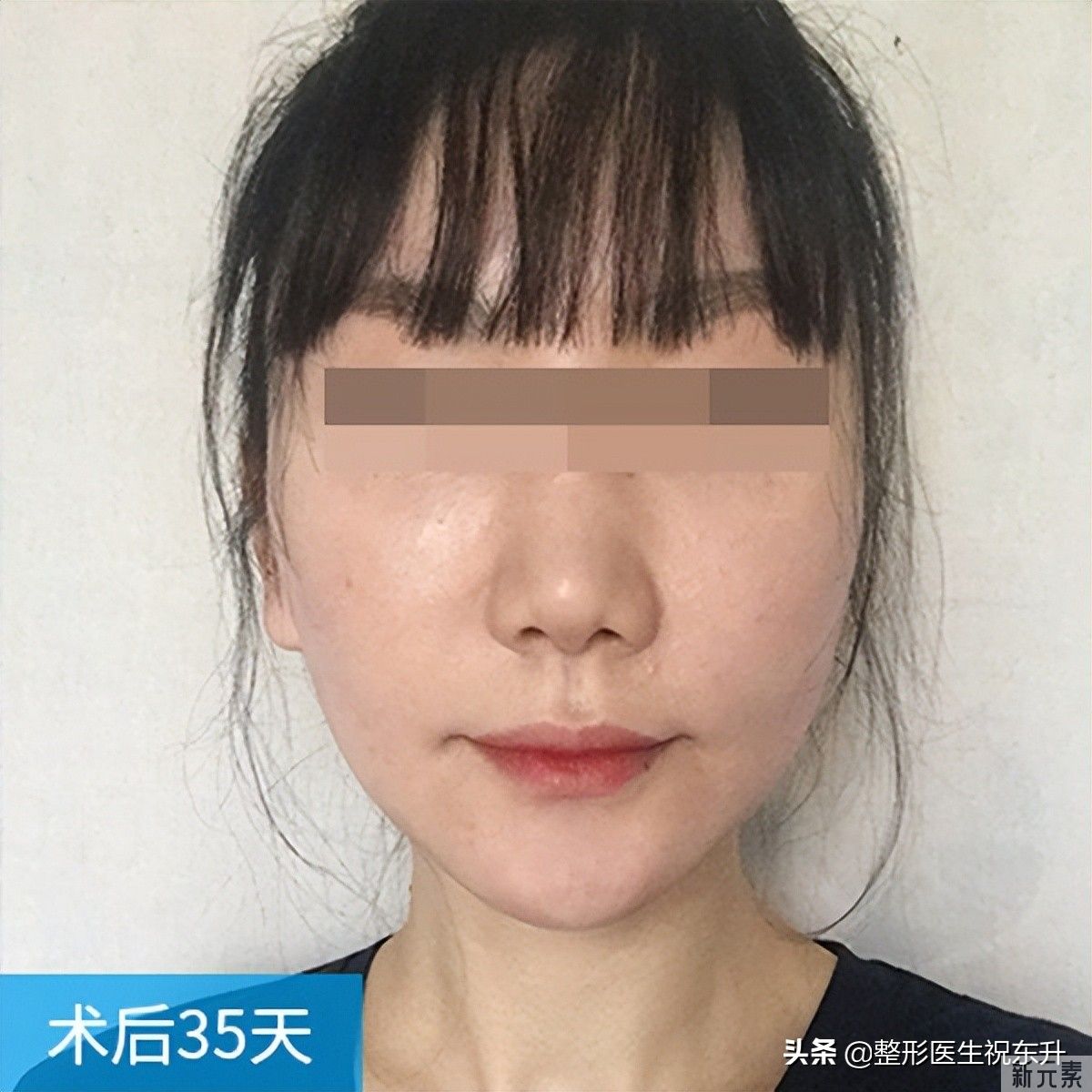 42岁大姐做了拉皮，终于摆脱自卑，变身漂亮“小姐姐” 图片-2