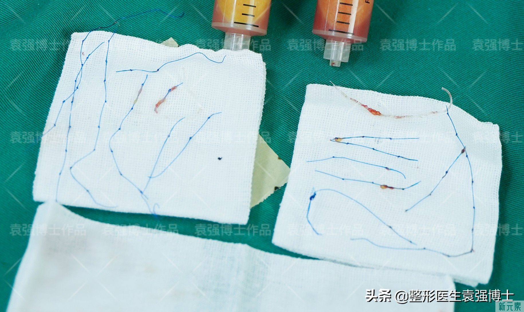 3次热玛吉，2次线雕，皮下满是瘢痕，大拉皮后她“大变样” 图片-5