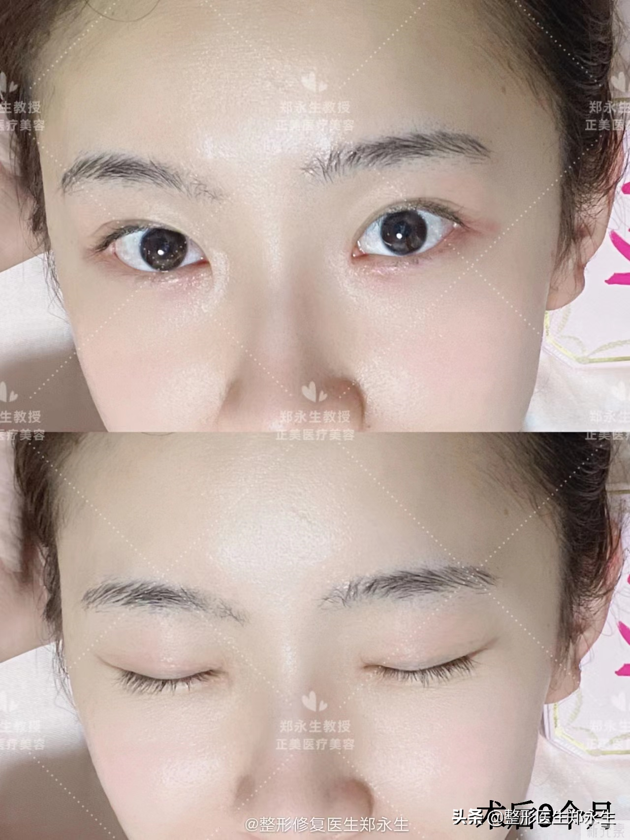 骗过所有人的双眼皮，你能分辨是真是假吗? 图片-8