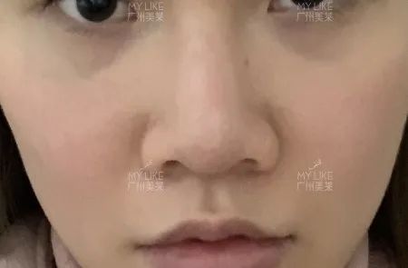 Lisa妹妹鼻子的事藏不住了!! 图片-18