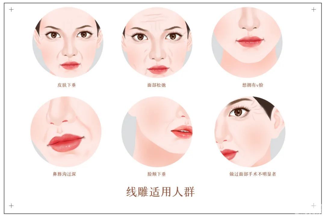 左手拉皮、右手线雕，两大面部抗衰利器怎么选? 图片-7