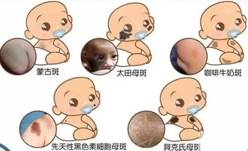 胎记治疗越快越好?治疗胎记不要陷入这几个误区 图片-11