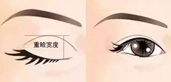 双眼皮做的太宽了，能变窄吗? 图片-5