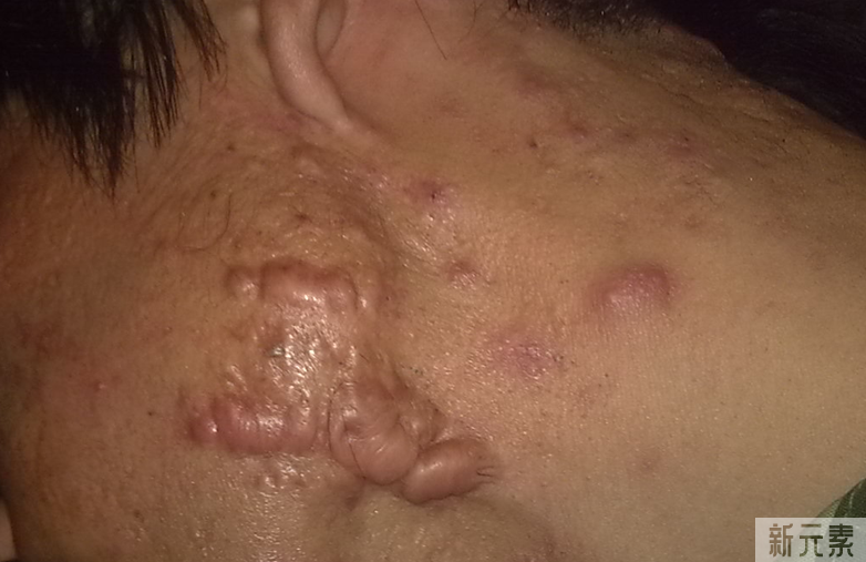 如此的抗痘成果，是怎么做到的? 图片-4