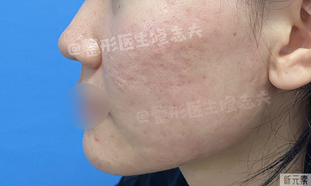 如此的抗痘成果，是怎么做到的? 图片-6
