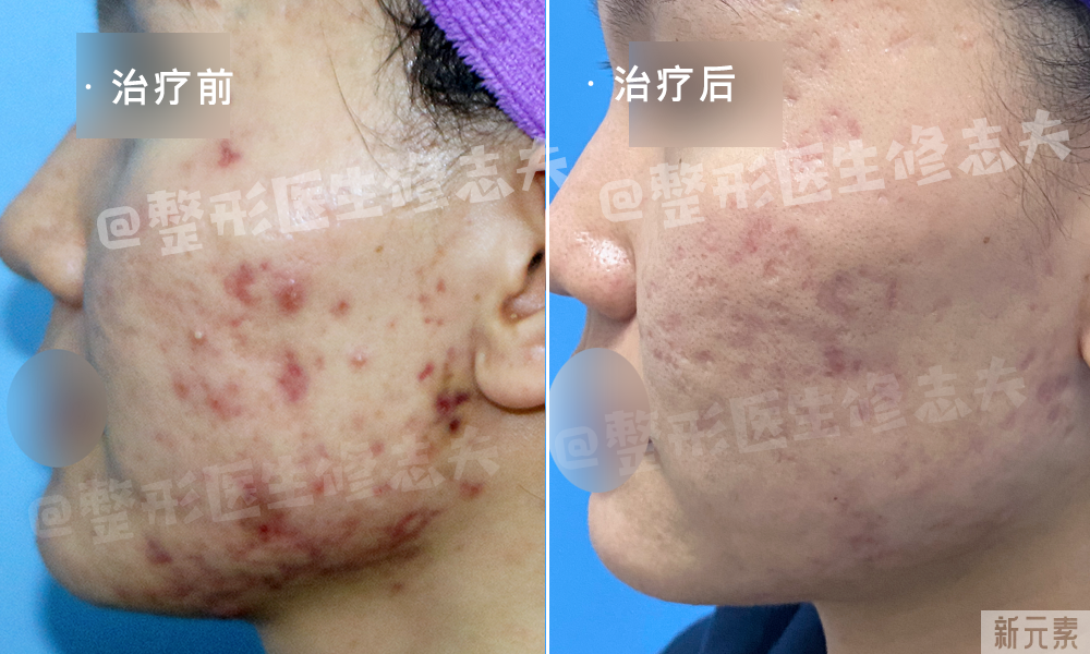 如此的抗痘成果，是怎么做到的? 图片-10