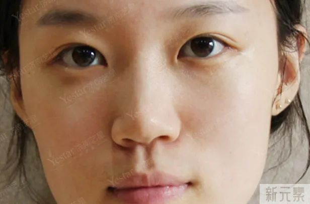 超皮秒VS蜂巢皮秒，哪个祛斑更适合你? 图片-11