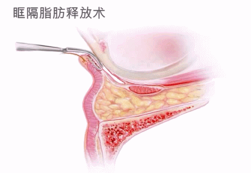 泪沟填充有6大常见方法(3)想知道哪种更适合你吗? 图片-2
