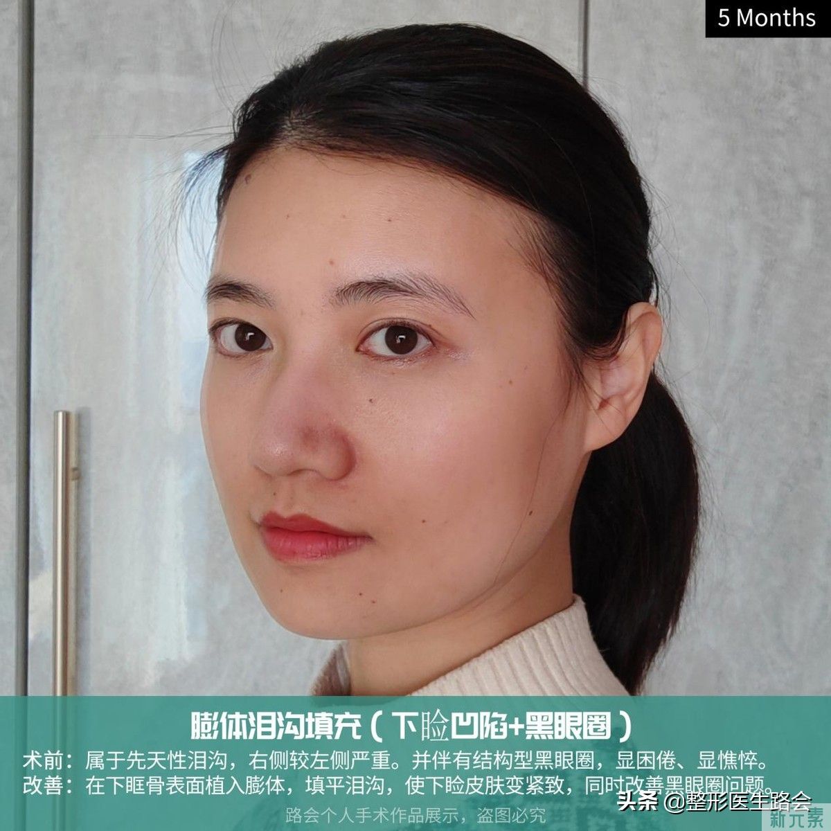 泪沟填充有6大常见方法(3)想知道哪种更适合你吗? 图片-6