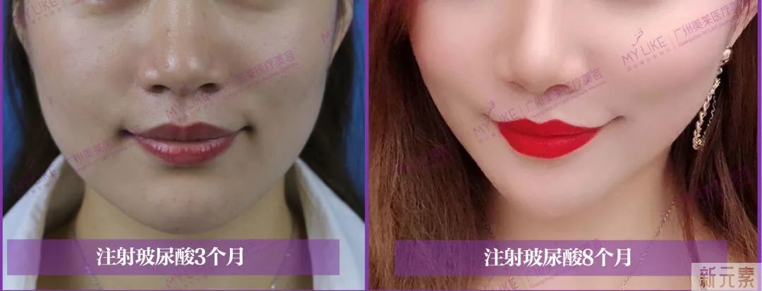 小s近照脸好僵，网友:打了1斤玻尿酸? 图片-9