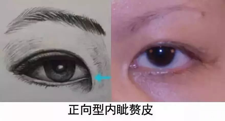 如何判断自己是否需要开眼角?请对号入座~ 图片-3