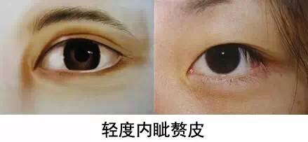 如何判断自己是否需要开眼角?请对号入座~ 图片-7