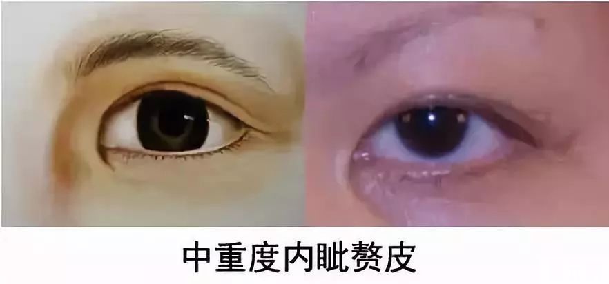 如何判断自己是否需要开眼角?请对号入座~ 图片-8