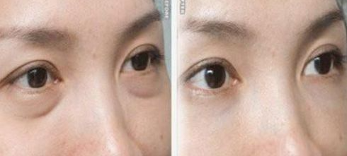 明明长在差不多的位置，凭什么别人的就是卧蚕? 图片-5