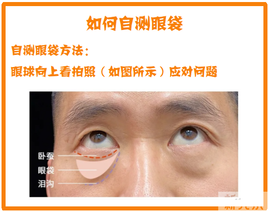 明明长在差不多的位置，凭什么别人的就是卧蚕? 图片-3