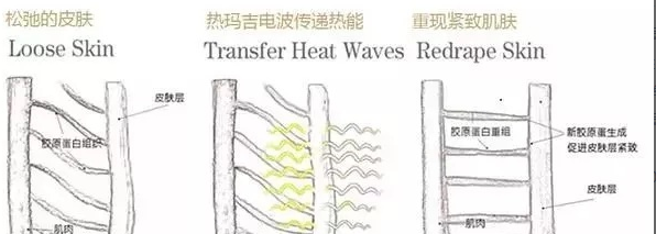 热玛吉让你年轻的秘密，你知道吗? 图片-4