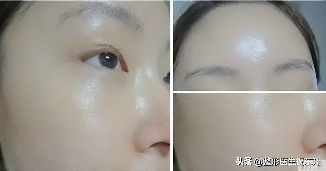 打算做水光针的人，不懂这些，小心多走 图片-1