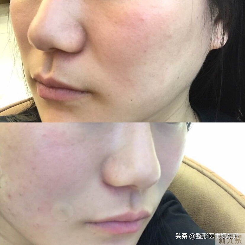 【法令纹太深，看起来很显老，到底该怎么办 图片-1